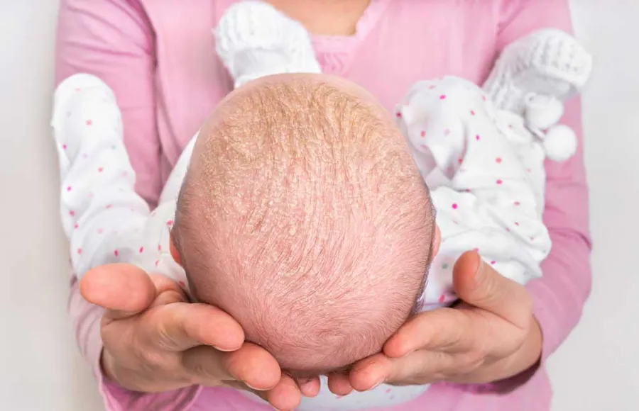 Costra láctea del bebé 