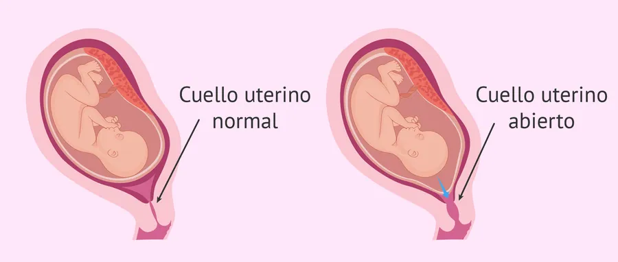Cuello uterino incompetente