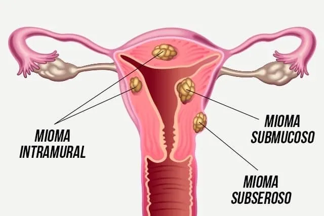 Fibroma uterino: causas, síntomas y tratamiento