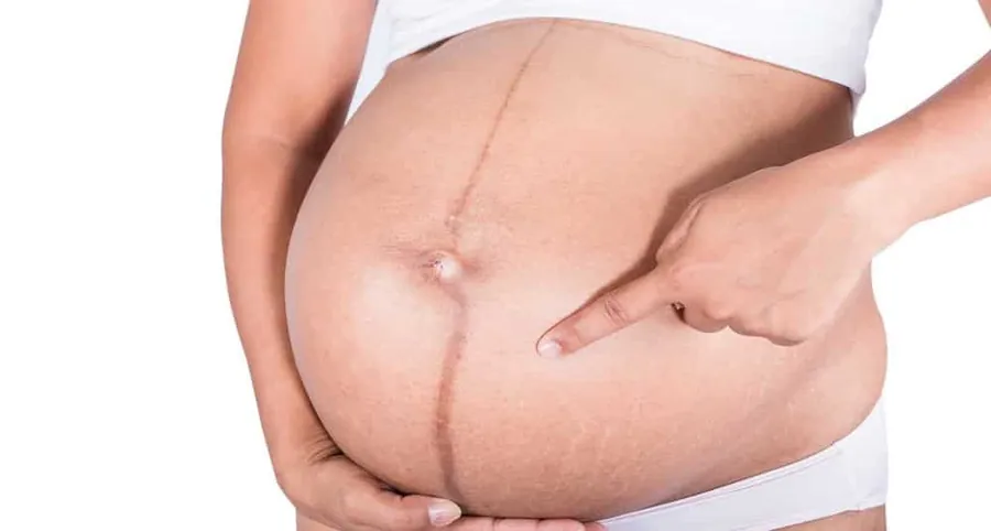 Manchas en el embarazo: melasma, paño y cloasma