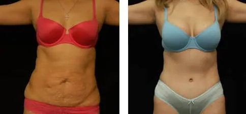 Mommy makeover: Cirugía estética después del embarazo