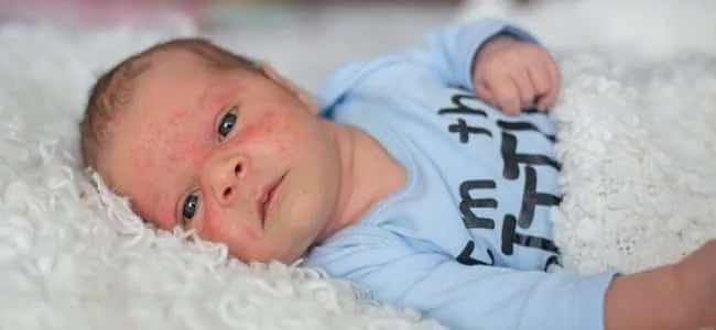 ¿Cómo prevenir el eczema en bebés?