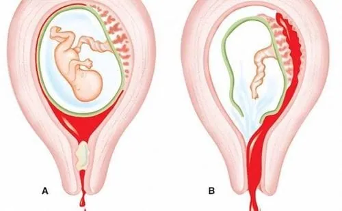 Tipos de abortos involuntarios y naturales