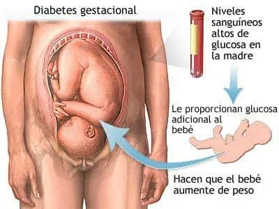 Diabetes gestacional