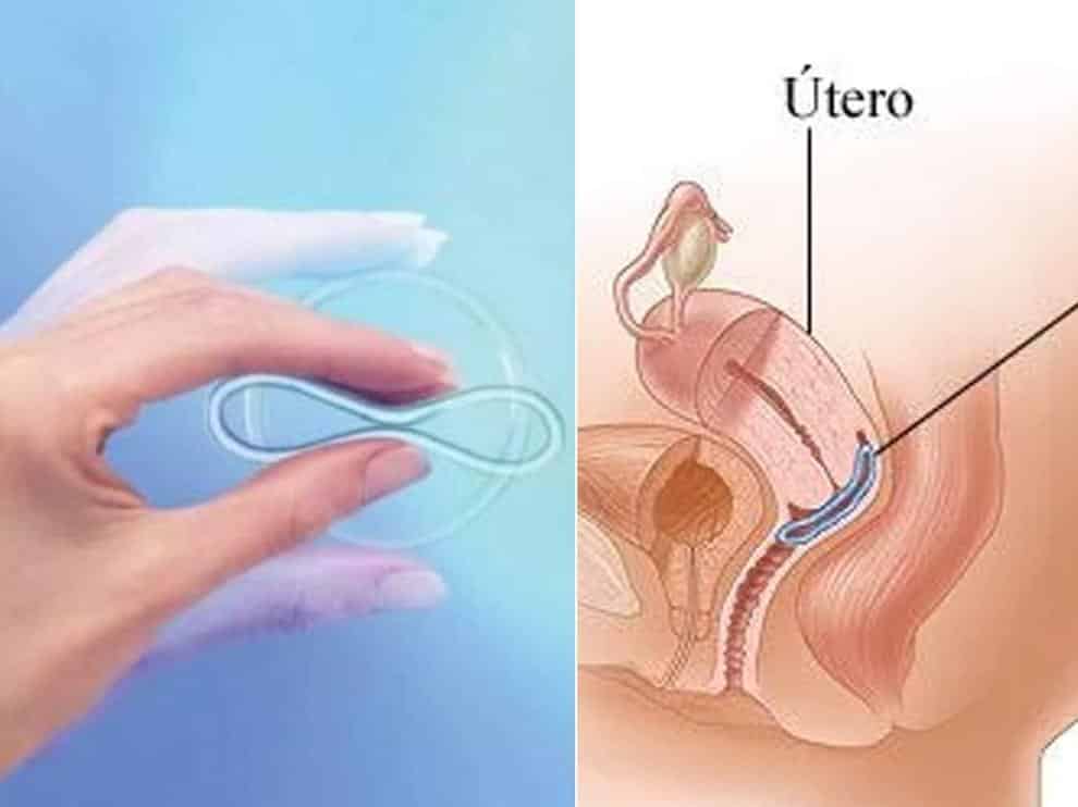 Anillo anticonceptivo vaginal